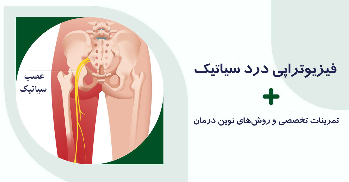 عصب سیاتیک