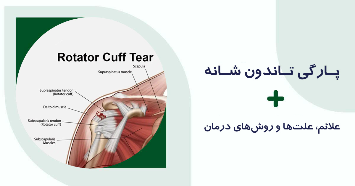 پارگی تاندون شانه