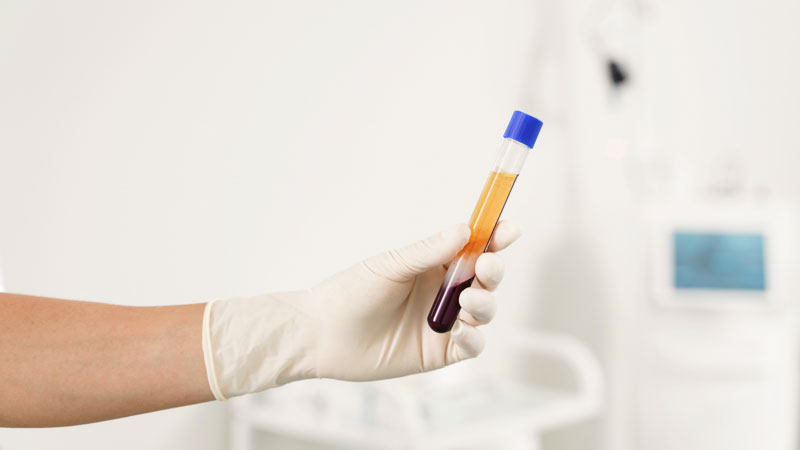 فرآیند تهیه پی آر پی prp