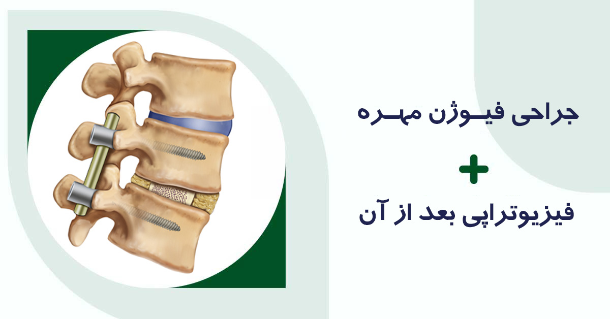 جراحی فیوژن مهره و فیزیوتراپی آن