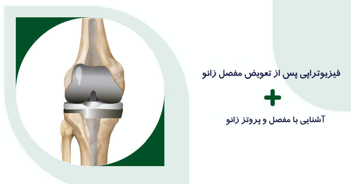 فیزیوتراپی پس از تعویض مفصل زانو