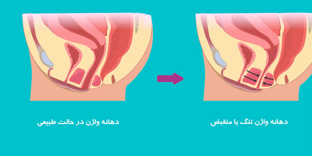 واژینیسموس چیست