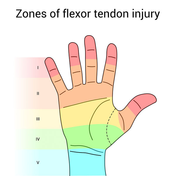 طبقه‌بندی نواحی آسیب تاندون فلکسور دست (Zones I–V)