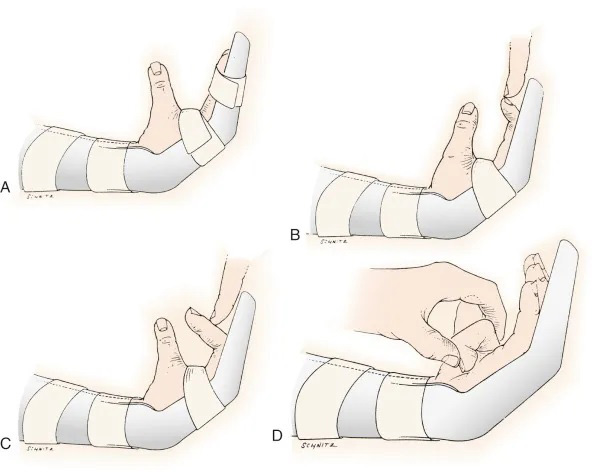 توانبخشی تاندون فلکسور