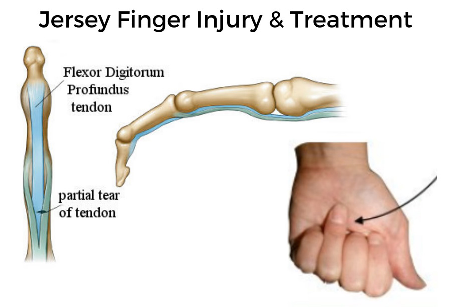 Jersey Finger – پارگی تاندون FDP