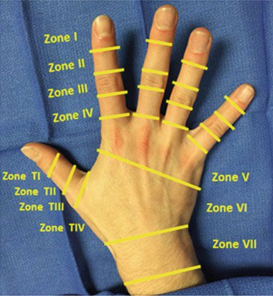 ناحیه‌بندی (زون‌بندی) تاندون اکستانسور دست