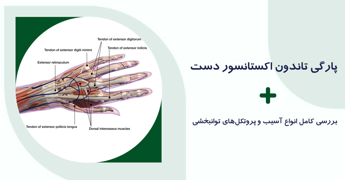 پارگی تاندون اکستانسور دست؛ بررسی کامل انواع آسیب و پروتکل‌های توانبخشی