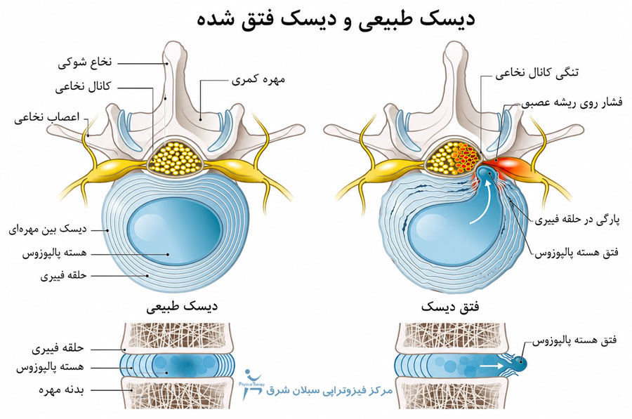 مقایسه دیسک طبیعی و دیسک فتق شده