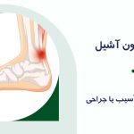 پارگی تاندون آشیل